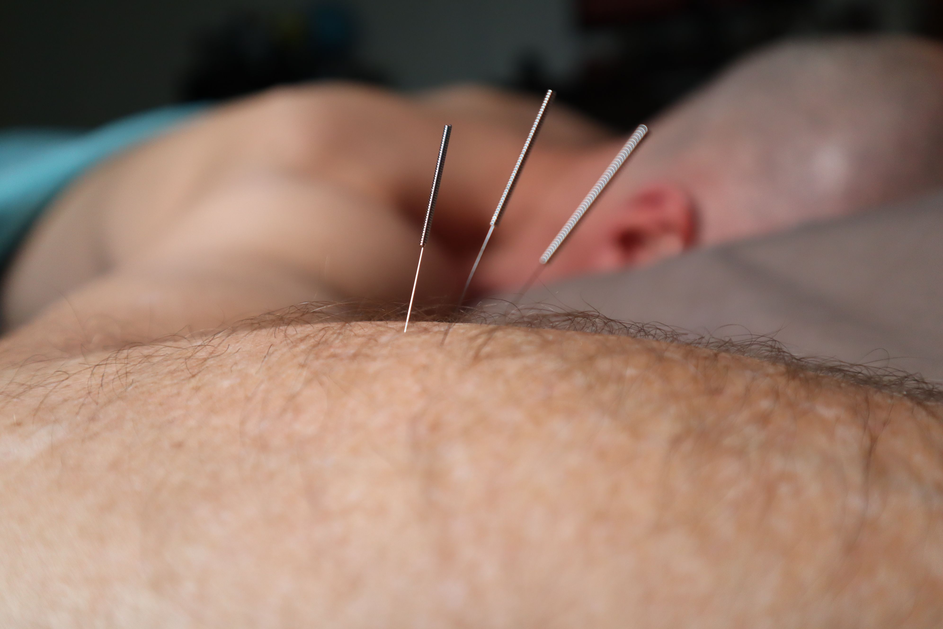 Dry Needling vs. Acupuncture: What's the Difference?